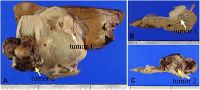 Case Report: A Case of Gallbladder Carcinosarcoma With Osteoclast-like Multinucleated Giant Cells that Was Associated With RANK‐RANKL Signaling